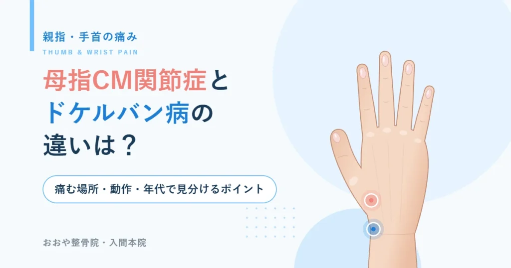 母指CM関節症とドケルバン病の違い