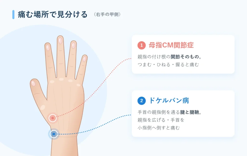 母指CM関節症とドケルバン病の痛む場所